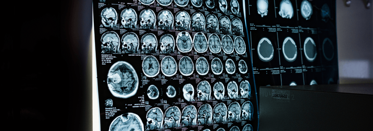 Early Warning Signs of Traumatic Brain Injury After an Accident