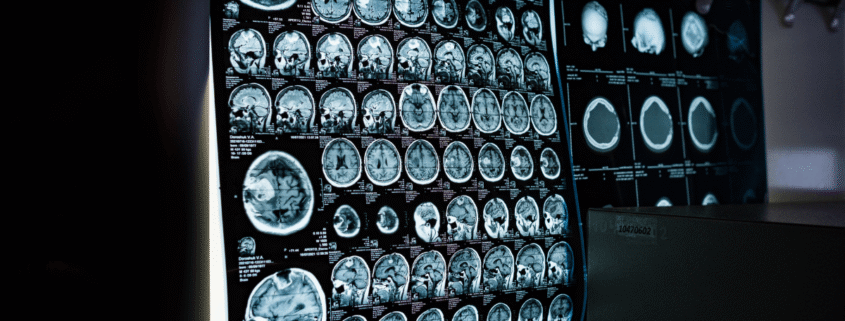 Early Warning Signs of Traumatic Brain Injury After an Accident